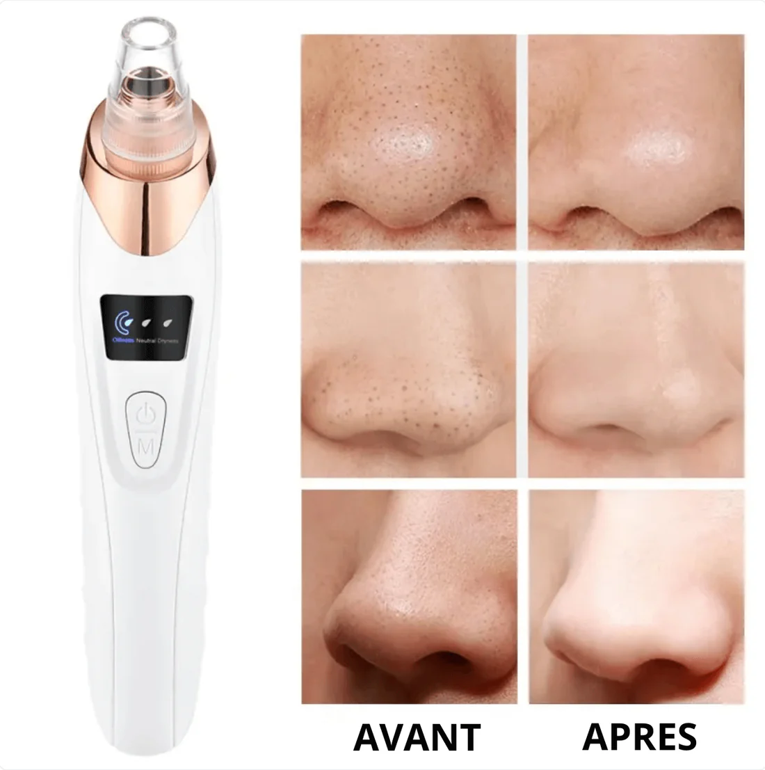 Aspirateur de Graisses & Points Noirs  SkinPro™